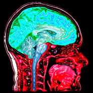 IRM du cerveau vue mdiane